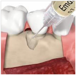 エムドゲインの塗布