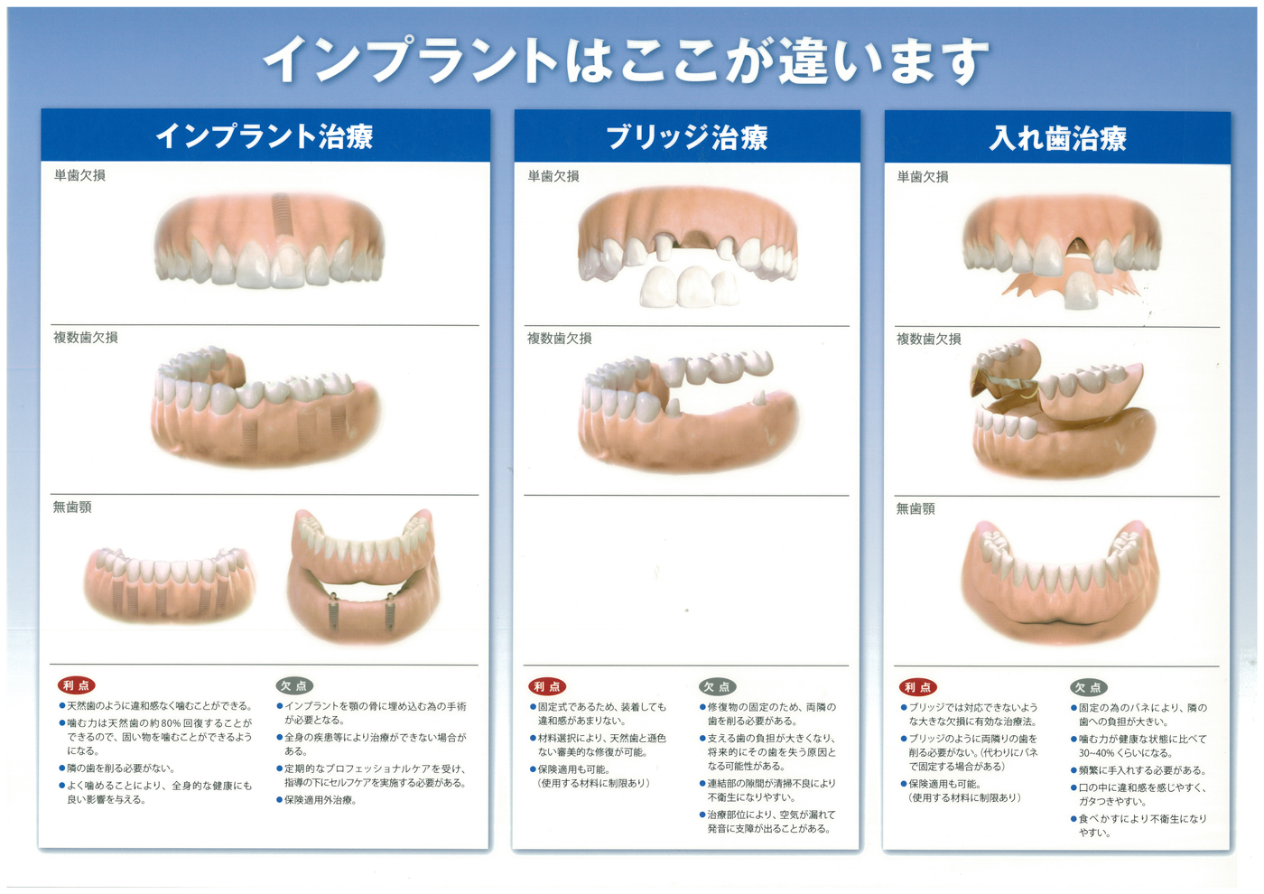 インプラントはここが違います